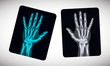 Radiography. Picture of human hands on the film. Vector