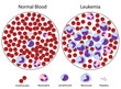 © Alila Medical Media - Leukemia versus normal blood