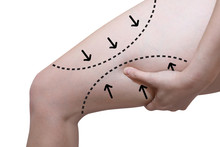 Woman Grabbing  Her Thigh  With The Arrow Line In  Liposuction Cellulite Removal Concept