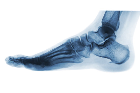 Fototapete - X-ray normal human foot . Lateral view . Invert color style .