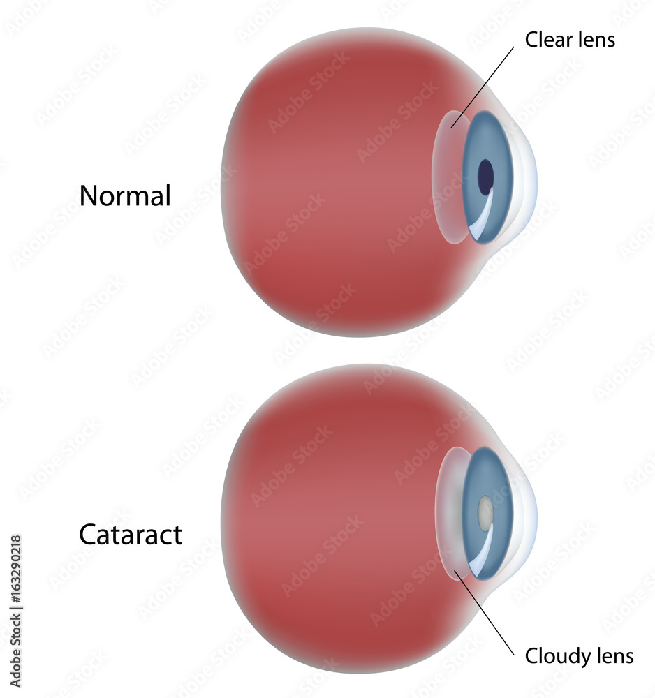 Cataract Explained Eye disease - cataract - clouding of the lens Stock Illustration ...