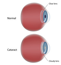 Eye Disease - Cataract - Clouding Of The Lens