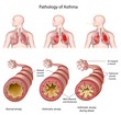 Anatomy of asthma, labeled. 