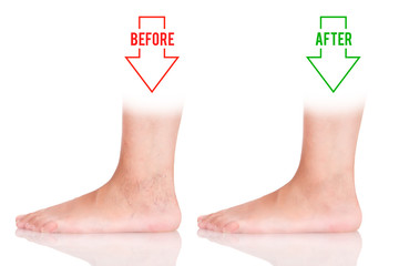  Variants of varicose before and after.