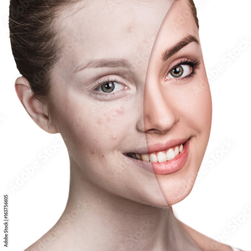 Poster Girl with acne before and after treatment