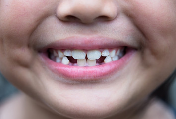 Little girl show broken teeth. the dropped-out milk Tooth. Close up Concept