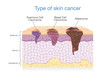 Skin layer have 3 Type of Cancer in one. Illustration about Medical diagram.