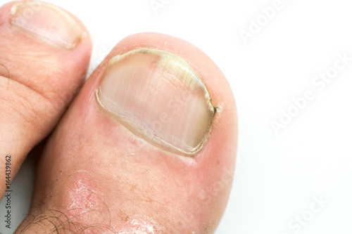 Fotografía Closeup of Psoriasis vulgaris on the mans foot finger nails with plaque, rash and patches, isolated on white background