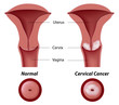 © Alila Medical Media - Cervical cancer