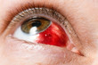 Subconjunctival hemorrhage - hyposphagma. Closeup of woman's face showing red bloodshot eye with browm iris, looked up and right very close