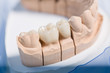 Prothesensattel mit Zahnersatz im Zahnlabor
