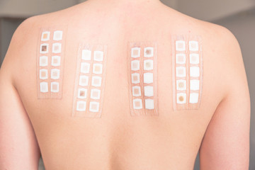 alergy patch test on the back of a young woman