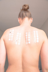 alergy patch test on the back of a young woman