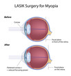 Lasik eye surgery for myopia before and after