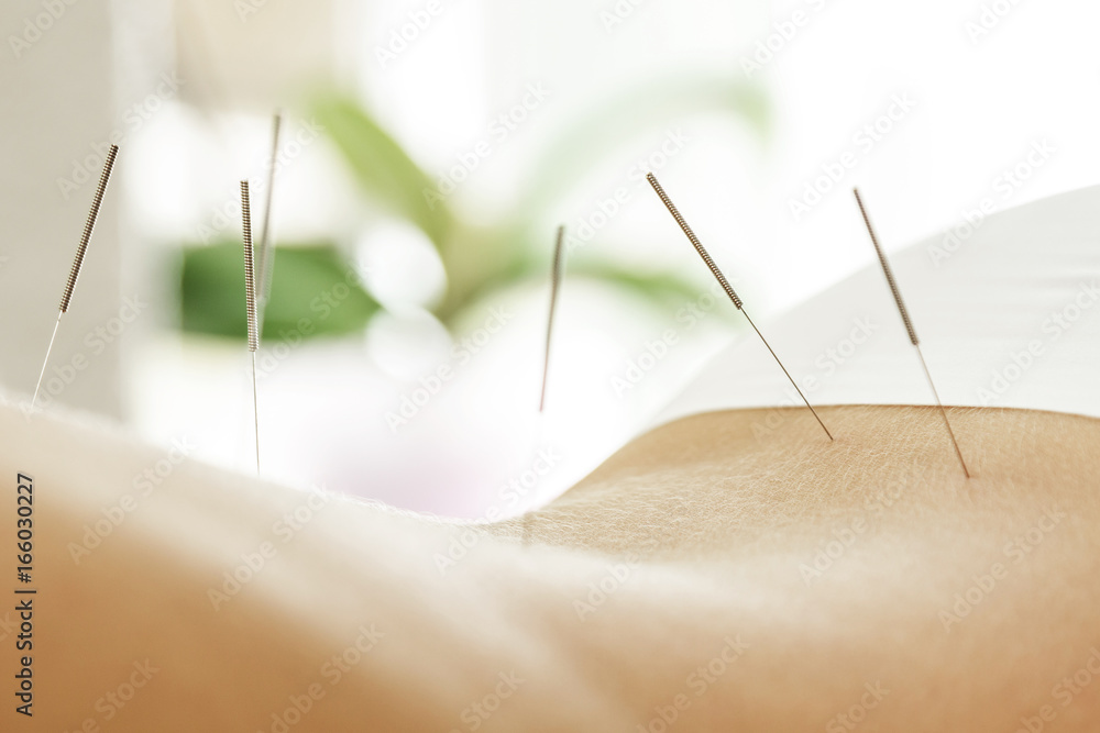 Female back with steel needles during procedure of acupuncture therapy - obrazy, fototapety, plakaty 