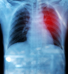 Naklejka na meble X-ray film of chest and stomach under dome of the diaphragm red zone is pain.