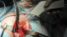 Surgeon Uses Pulsed Irrigation Device In Hip Replacement Surgery Close-up