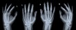 Röntgenbild Hand Hände