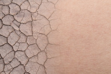 Dry Woman Skin Texture With Dry Soil