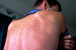 Dangerous sunburn. The shoulders and spine of caucasian man