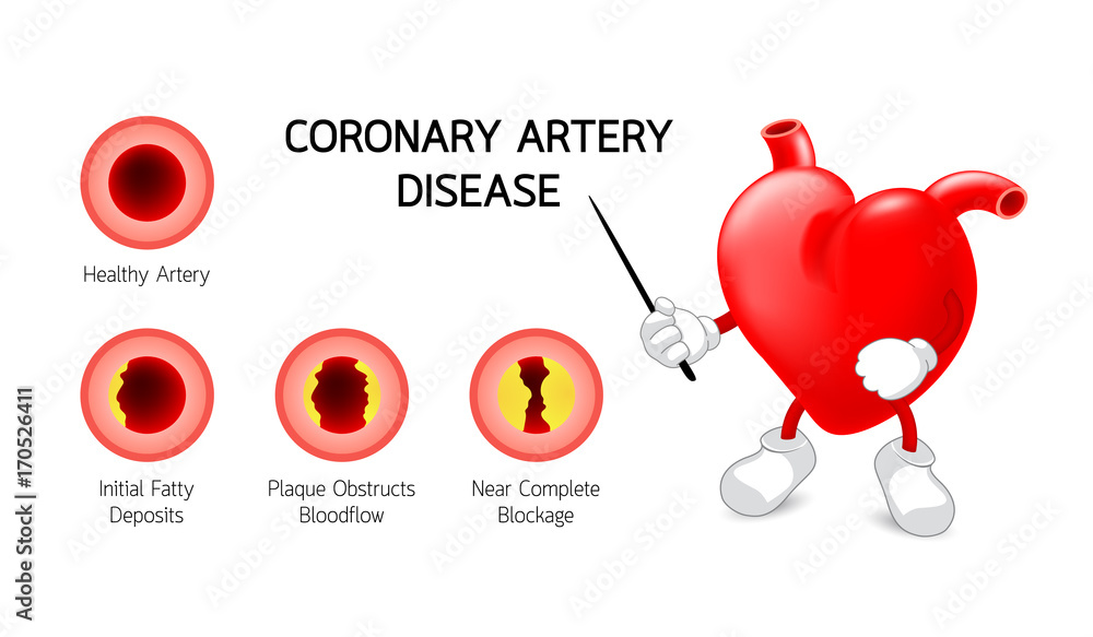 Heart character with Coronary Artery Disease infographic. Heart ...
