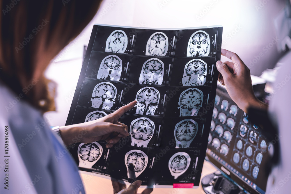 brain atrophy on MRI of Dementia patient - obrazy, fototapety, plakaty 