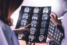 Brain Atrophy On MRI Of Dementia Patient