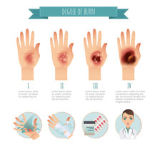 Degree Of Skin Burns. Burns Treatment. Vector Infographic. Flat Illustration For Websites, Brochures, Magazines Etc