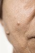 © Voyagerix - Elderly pensioner female, dermal fibroma closeup.