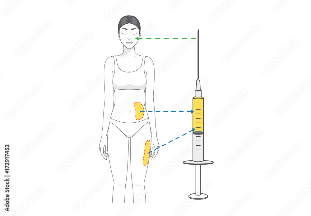 Fat Injection Animated Beauty woman make fat transfer from buttocks to facial for wrinkles ...