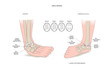 Two common types of ankle sprain (inversion and eversion)