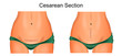 sutures after cesarean section