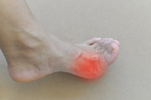 Painful And Inflamed Gout..