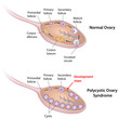 Polycystic ovary syndrome, labeled. 