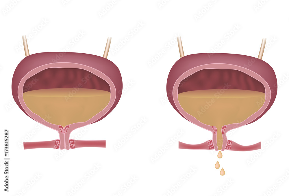 Stress urinary incontinence in women, unlabeled Stock Illustration ...