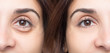 © Alessandro Grandini - Woman eye before and after cosmetic treatment with and without eye bag