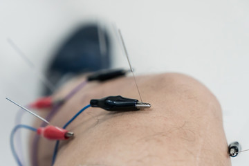 Adult male physiotherapist is doing acupuncture on the back of a female patient. Patient is lying down on a bed and is covered with royal blue towels.