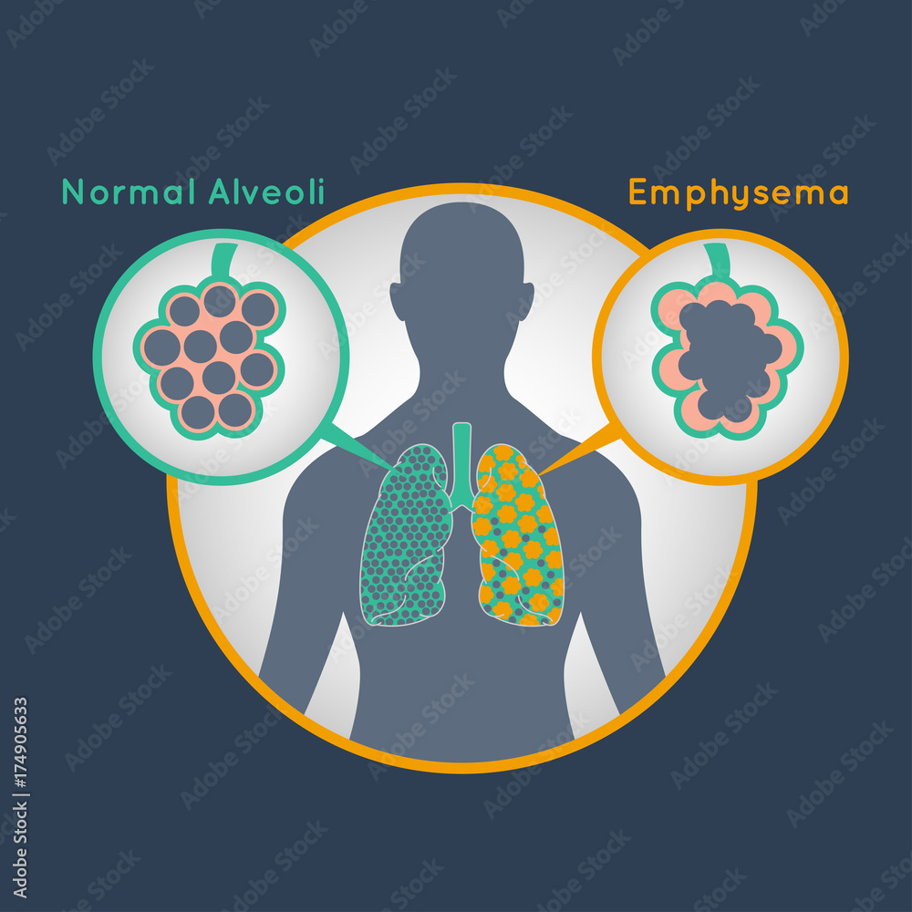 EMPHYSEMA vector logo icon illustration Stock Vector | Adobe Stock