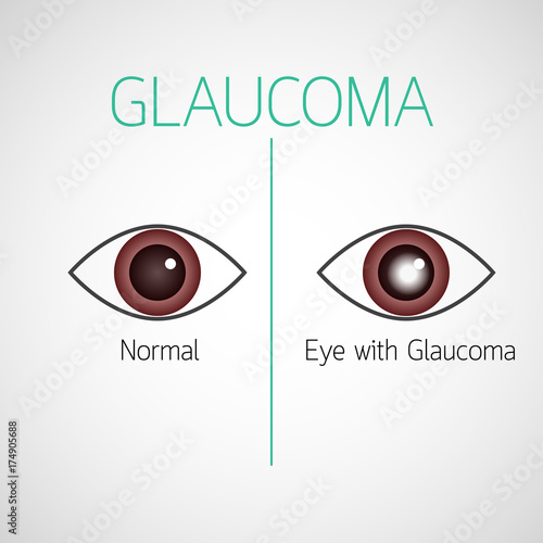 Fotografía Glaucoma vector icon illustration
