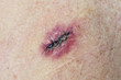 © Jackie Davies - Post operative stitched incision from the removal of a Basal Cell Carcinoma looking sore and infected