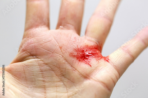 Fotografía Close up of a bleeding cut hand with tiny shards of glass.