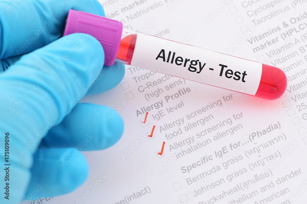 Allergy Lab Requisition Form Blood sample with requisition form for allergy test Stock Photo | Adobe ...