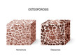 Osteoporosis. Bone tissue