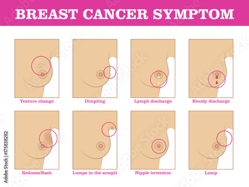 testing breast cancer Testing breast cancer