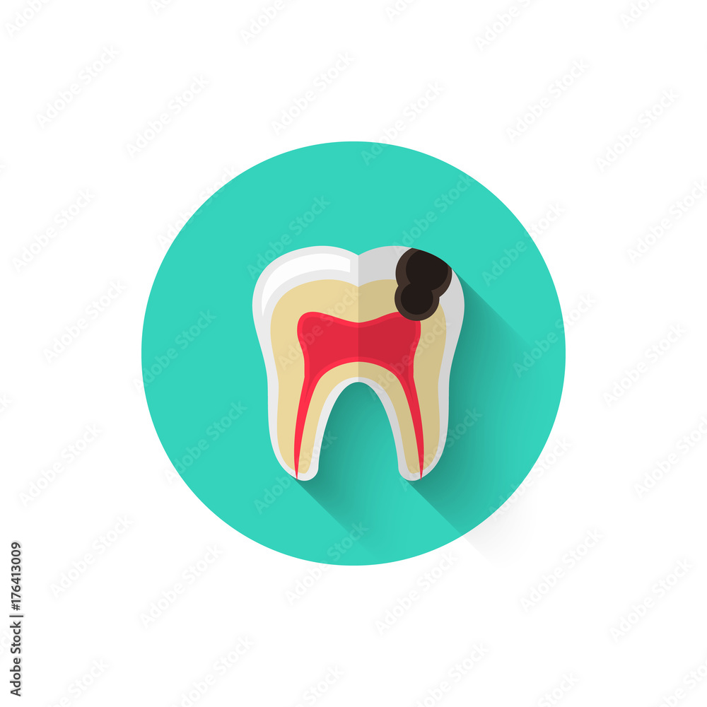 Tooth decay, caries illustrated in a flat style design of vector ...