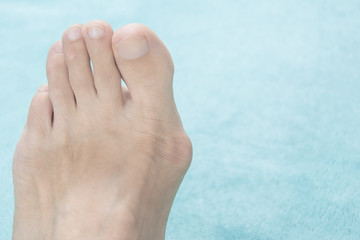 Wall Mural - Hallux valgus, bunion in a leg on a blue soft background