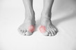 © HappyHaus - Hallux valgus, bunion in foot on white background