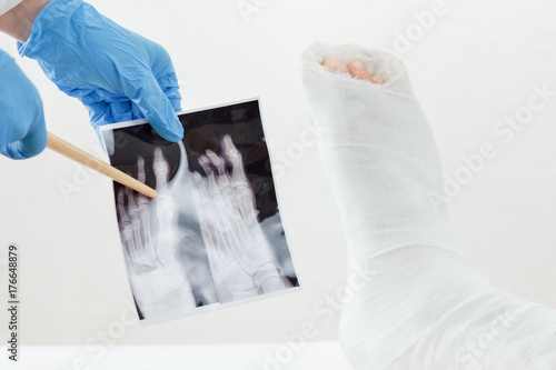 Doctor Examines X Ray Image Broken Leg Of The Patient In Plaster