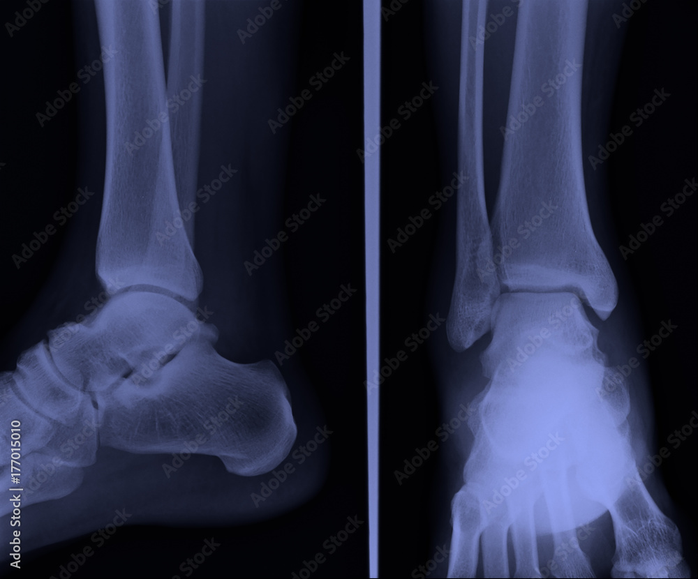 Ankle Rx x ray ankle ap lateral Stock Photo | Adobe Stock