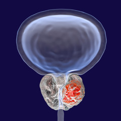 Sticker - Prostate cancer, 3D illustration showing presence of tumor inside prostate gland which compresses urethra